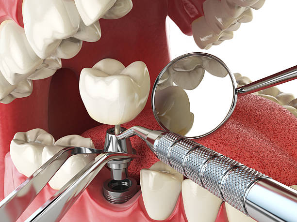 Best Emergency Wisdom Teeth Removal in Arabi, LA