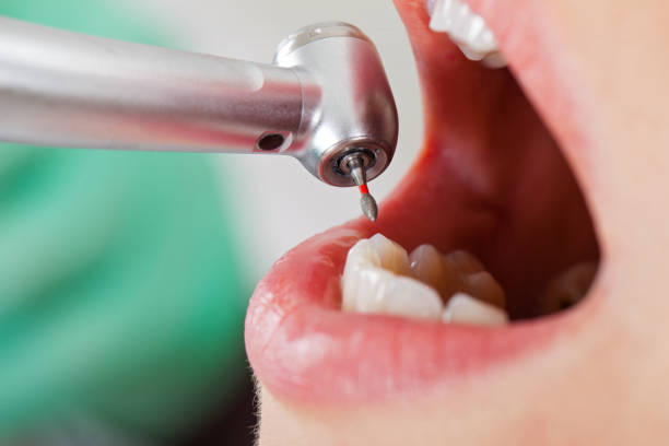 Best Emergency Broken Tooth Repair in Arabi, LA